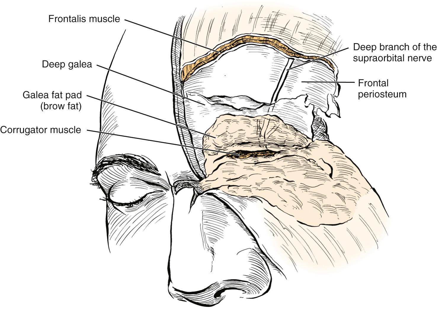 Fig. 25.6, The deep division of the supraorbital nerve runs in the floor of the glide plane space just superficial to the frontal periosteum. During a brow lift, if elevation of the forehead is errantly performed just superficial to the periosteum, this nerve can be injured. Injury to this nerve often causes parietal hypesthesia for 2 to 3 months followed by intense pruritus.