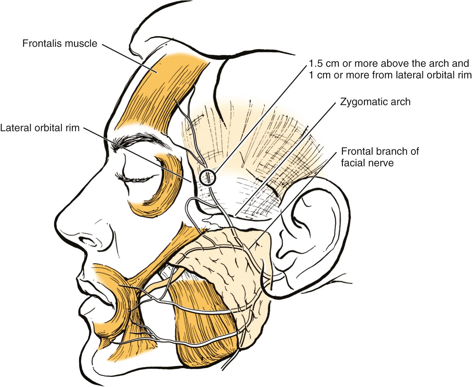 Fig. 25.7, The frontal branch of the facial nerve is quite deep over the zygomatic arch but transitions to a more superficial location just deep to the temporoparietal fascia above the arch. Recent anatomic studies suggest that the nerve enters this more superficial plane 1.5 cm or more above the arch and 1 cm or more from the lateral orbital rim. During endoscopic brow lift, the nerve is encountered in this more superficial “danger area.” Thus the nerve is best protected by elevating right on the temporalis muscle fascia. In doing so, the frontal branch will be safely elevated with the temporoparietal fascia.