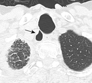 FIGURE 6.1, Tracheal diverticulum. Axial unenhanced computed tomography image demonstrates a large diverticulum connected to the trachea by a narrow neck (arrow) .