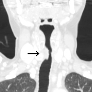 FIGURE 6.2, Idiopathic laryngotracheal stenosis. Coronal contrast-enhanced computed tomography image of the neck shows focal, eccentric, and lobulated soft tissue mass causing stenosis (arrow) of the proximal trachea.