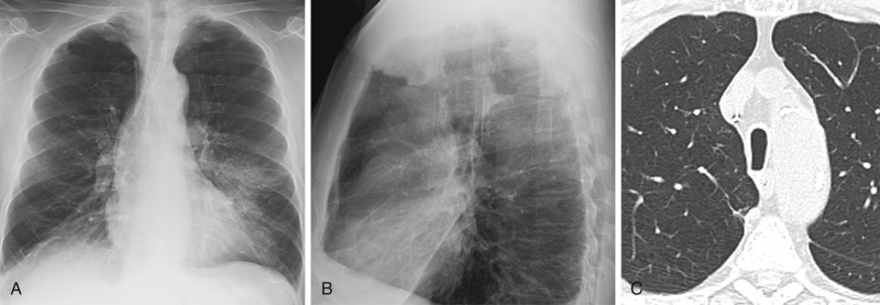 FIGURE 6.4, Saber-sheath trachea. Posteroanterior (A) and lateral (B) chest radiographs demonstrate narrowing of the trachea in the coronal plane but increased diameter in the sagittal plane and hyperinflated lungs. Axial unenhanced computed tomography image (C) of the same patient shows an increased anteroposterior diameter and decreased transverse diameter of the trachea.