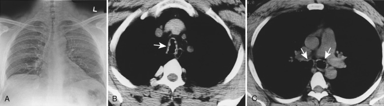 FIGURE 6.5, Posteroanterior chest radiograph (A) shows diffuse narrowing of the cervical and thoracic trachea. Axial computed tomography images (B, C) show nodularity (arrows) of the anterolateral cartilaginous wall of the trachea and main bronchi. Note the associated ossification and sparing of the posterior membranous tracheal wall.