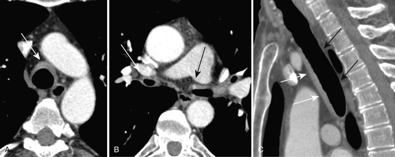 FIGURE 6.6, Relapsing polychondritis. Axial contrast-enhanced computed tomography (CT) images ( A and B ) show smooth wall thickening (arrows) involving the anterior and lateral walls of the trachea and bronchi. Sagittal contrast-enhanced CT image (C) of the same patient demonstrates smooth, long segment thickening involving the anterior tracheal wall (white arrows) and sparing of the posterior wall (black arrows) .