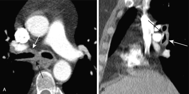 FIGURE 6.7, Granulomatosis with polyangiitis. Axial contrast-enhanced computed tomography (CT) image (A) shows smooth wall thickening (arrows) involving the anterior (white arrow) and posterior walls of the right mainstem bronchus. Sagittal formatted contrast-enhanced CT (B) of the same patient demonstrates thickening and calcification of the anterior wall (black arrow) and thickening of the posterior wall (white arrow) of the bronchus intermedius.