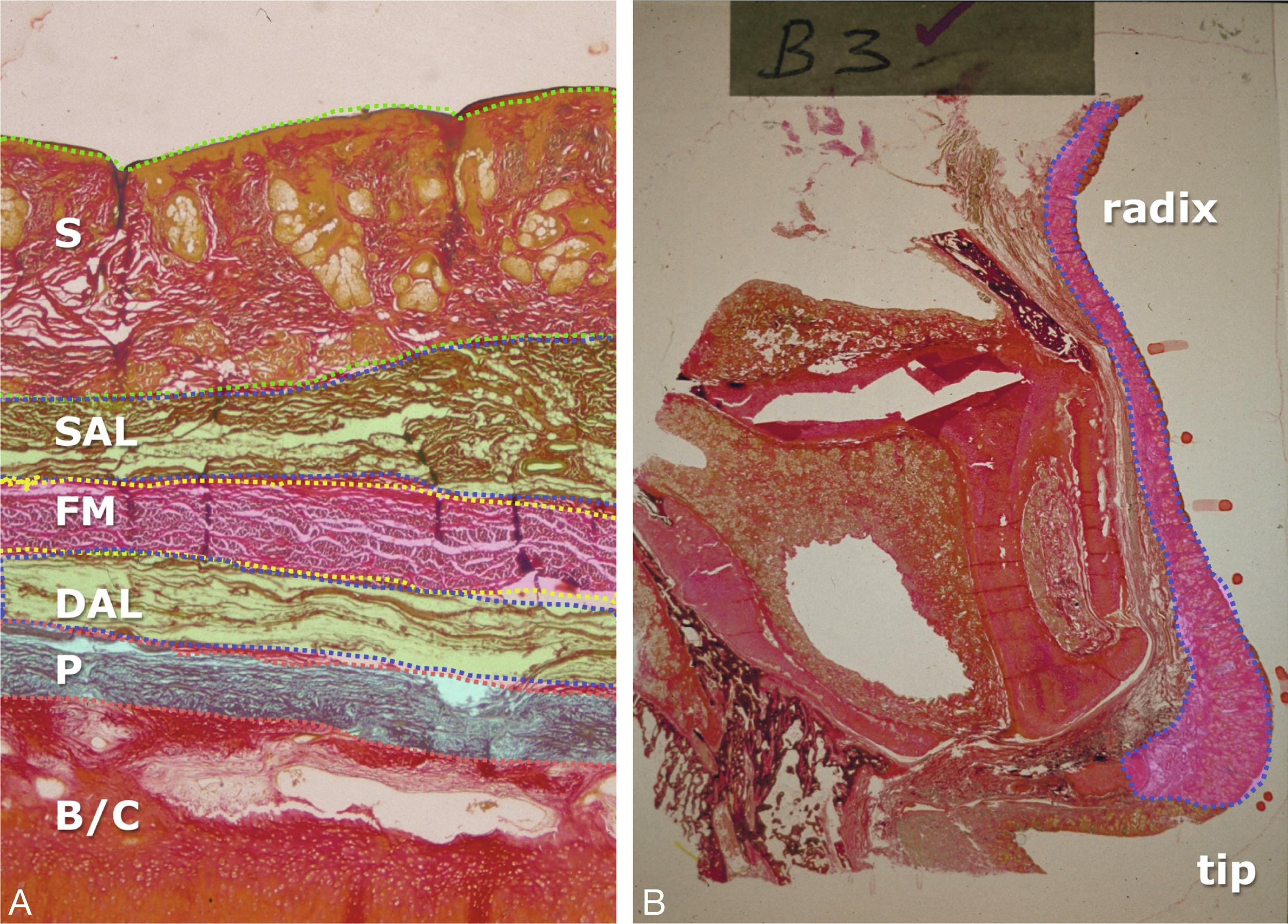 Fig. 22.1, (A) The five different soft tissue layers overlying the bony cartilaginous framework ( B/C ), namely: the overlying skin ( S ), superficial areolar layer ( SAL ), fibromuscular layer ( FM ), deep areolar layer ( DAL ), periosteum or perichondrium ( P ). (B) Sagittal section of the nose and septum showing the fibromuscular layer appearing as a continuous sheet sandwiched by the superficial and deep areolar layers. The thickness of the nasal skin increases from the radix to the tip.