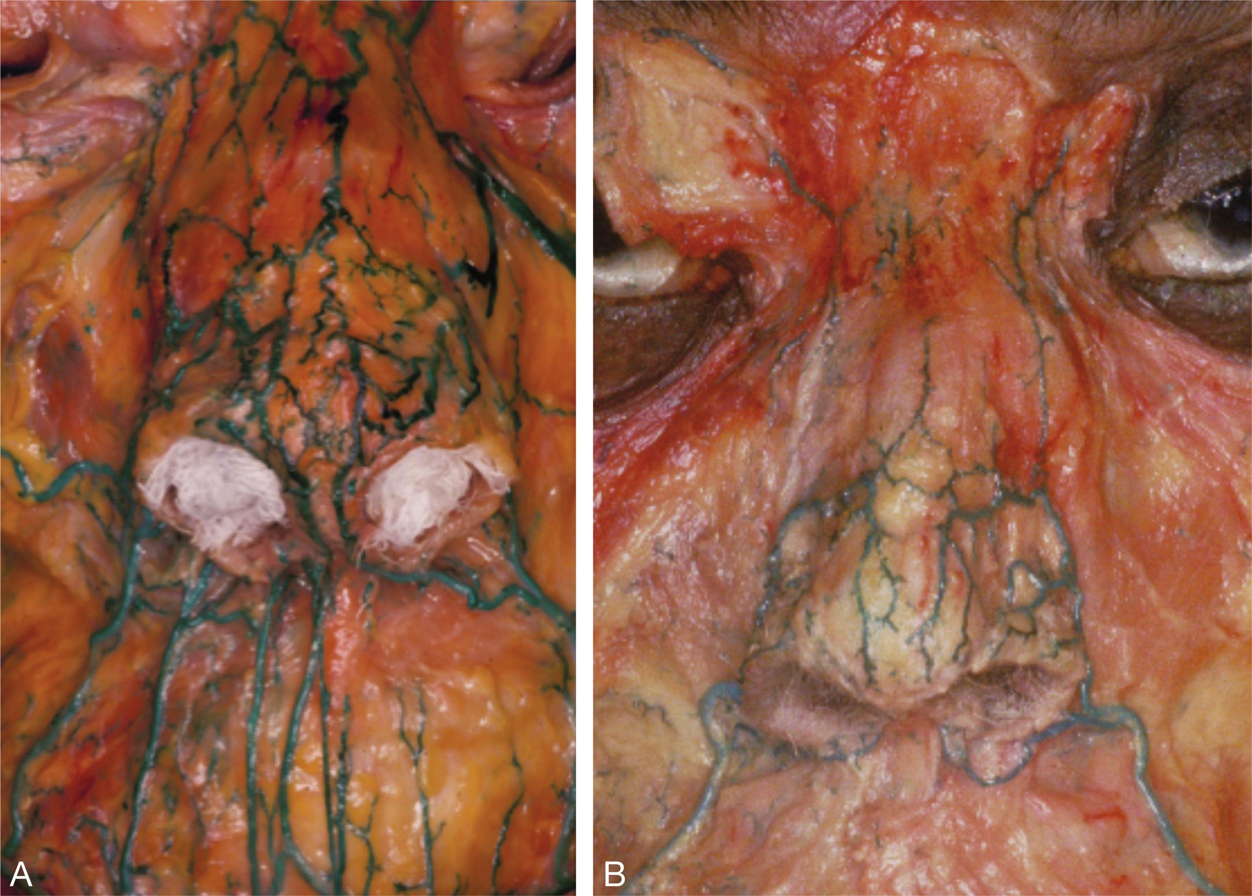 Fig. 22.3, (A, B) Over the nose, the arterial supply is from paired the alar, columellar (derived from the facial artery), and dorsal nasal (a branch of the ophthalmic artery) arteries on either side, with a vascular watershed in the midline. The midline of the nose is therefore an anatomically safe place for sharp-needle injections, which should endeavor to be delivered deep on the underlying bone or cartilage of the nose. In these separate specimens, the facial artery is seen coursing upward through the nasolabial region to the junction of the alar lobule with the lip, where it splits into a robust columellar artery, which runs in the nostril sill, and then along the columella to the tip of the nose and an alar artery, which curves around the alar groove and supplies the alar lobule (B). An attenuated tributary of the alar artery continues toward the medial canthus of the eye, where it anastomoses with the dorsal nasal artery, which in turn is a terminal branch of the ophthalmic artery (A). Note the paired columellar arteries running superficially along the columella to the tip of the nose, where they anastomose with the alar plexus, which unites branches from the columellar, alar, and dorsal nasal arteries.