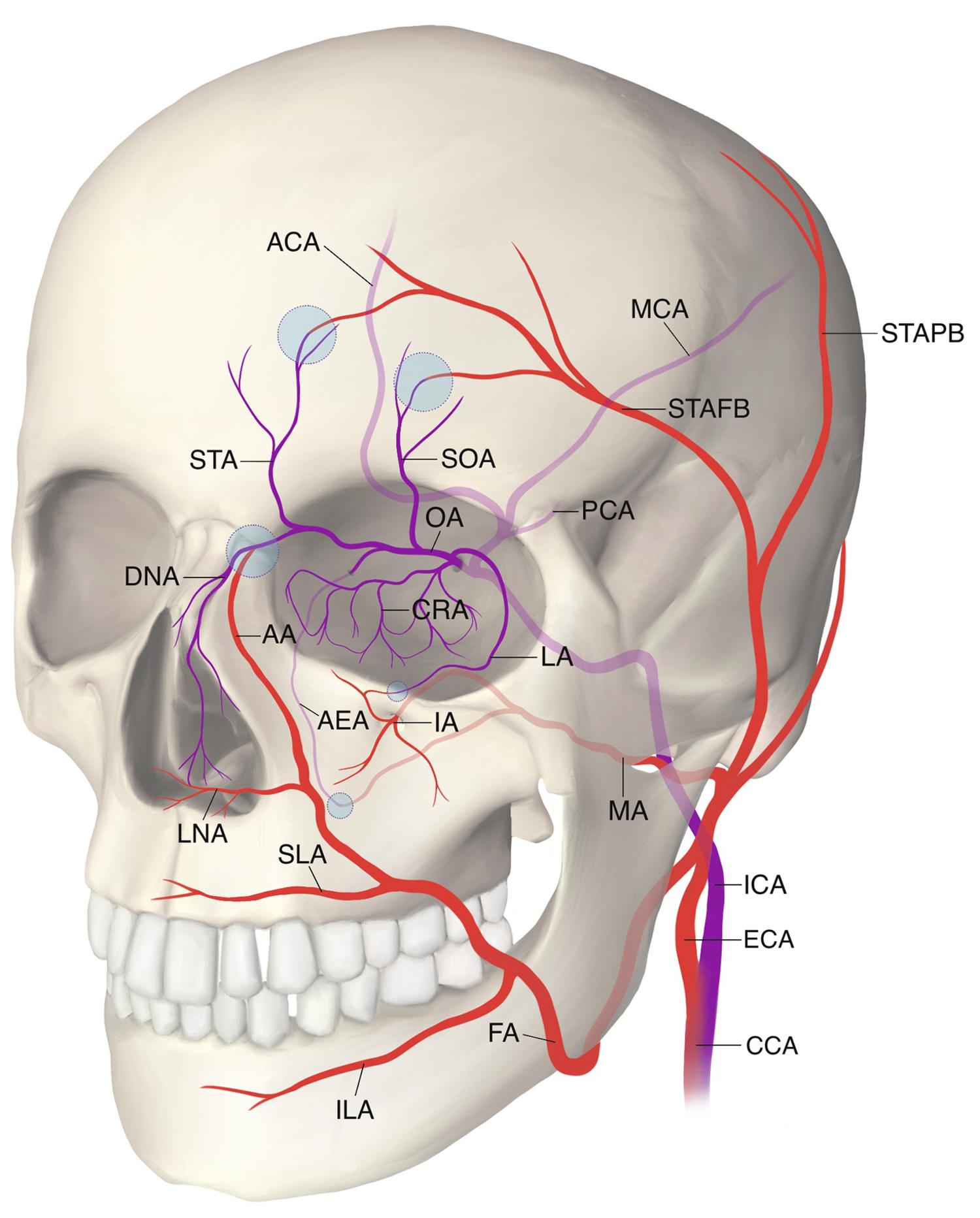 Fig. 22.4, Schematic diagram showing the extracranial branches of the ophthalmic artery and the anastamotic branches ( purple circle ) of the internal carotid artery ( blue ) and the external carotid artery ( red ). AA , angular art; ACA , anterior cerebral art; AEA , anterior ethmoidal art; CCA , common carotid art; CRA , central retinal art; DNA , dorsal nasal art; ECA , external carotid art; FA , facial art; IA , infraorbital art; ICA , internal carotid art; ILA , inf labial art; LA , lacrymal art; LNA , lateral nasal art; MA , maxillary art; MCA , middle cerebral art; OA , Ophthalmic art; PCA , posterior cerebral art; SLA , superior labial art; SOA , supraorbital art; STA , supratrochlear art; STAFB , superficial temporal artery frontal branch; STAPB , superficial temporal artery parietal branch. Artwork created by R. Dong, reproduced with permission from the author .