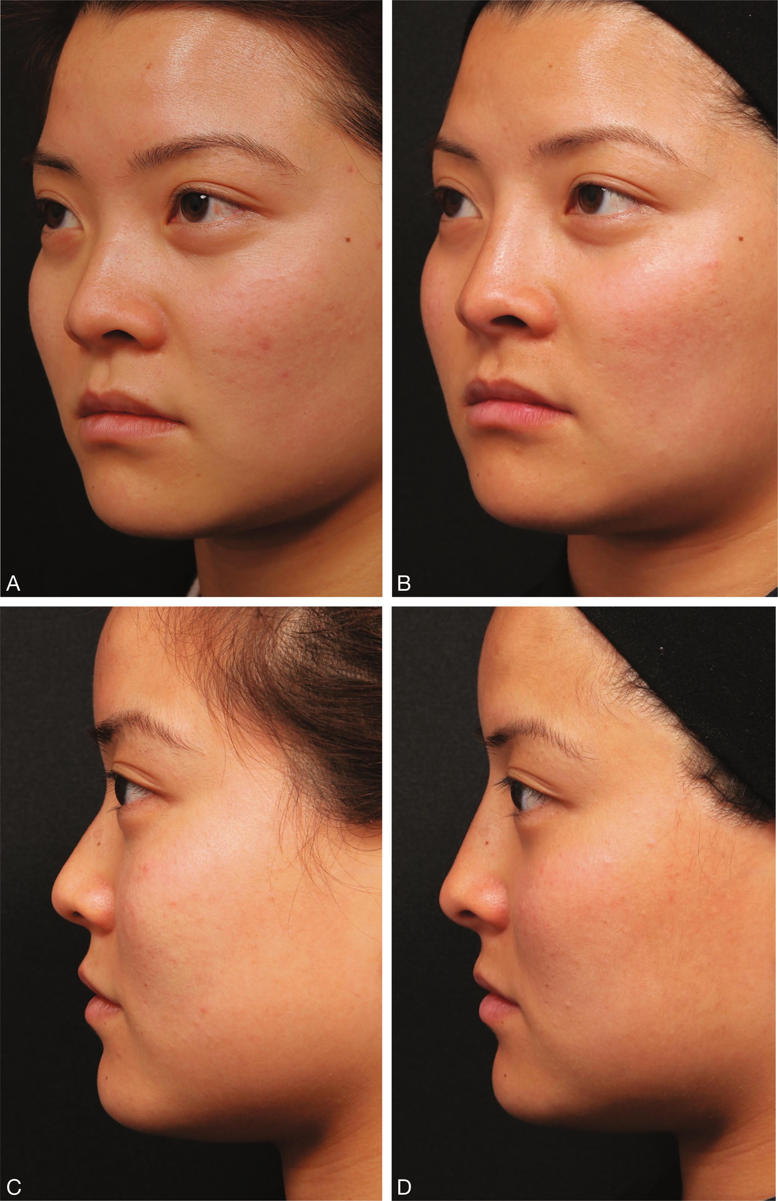 Fig. 22.5, (A–D) A young Asian female requested a higher nasal dorsum and more definition to her nose tip. A total of 1.5 mL of hyaluronic acid (HA) was used: 0.9 mL of the HA filler was placed at the nasal spine and columella to create a better projection of the nasal tip from the facial plane, whereas 0.6 mL of the same HA filler is placed on the nasal dorsum and nasal tip to create a higher nasal bridge, better definition of the nasal tip, and elongation of the nasal profile.