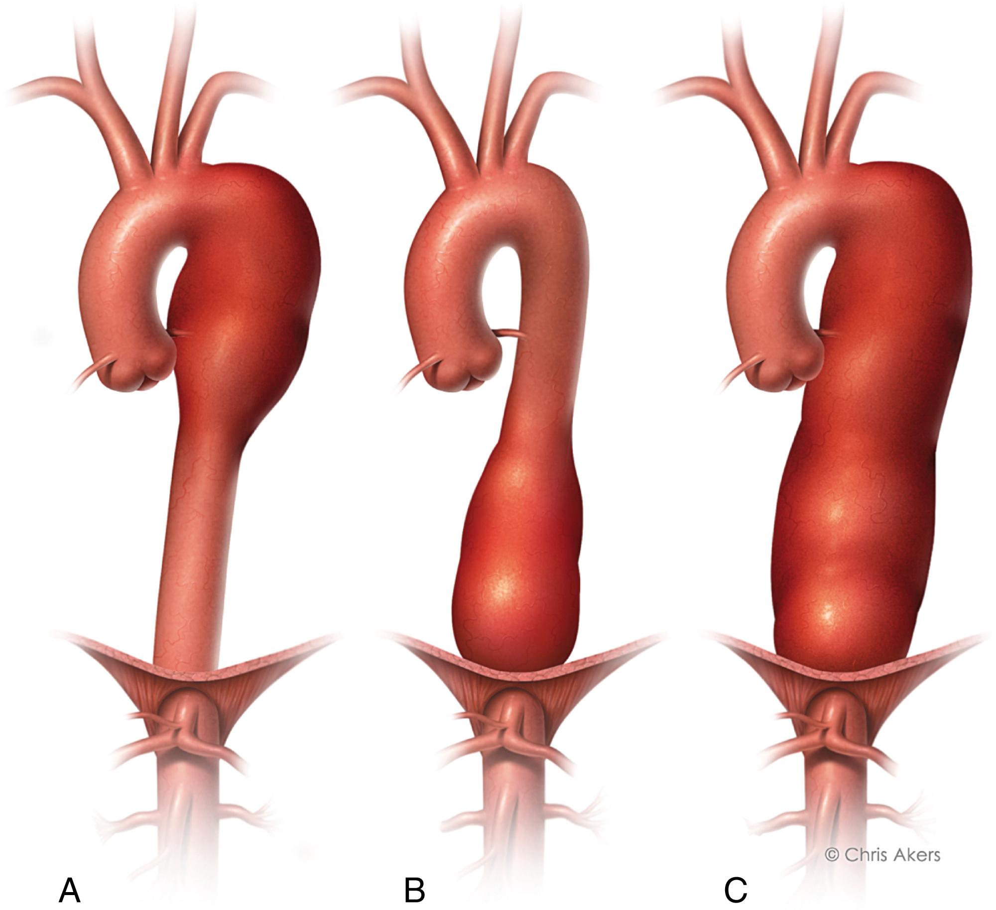 Fig. 62.3, Classification, descending thoracic aortic aneurysm. (A) Type A, distal to the left subclavian artery to the sixth intercostal space. (B) Type B, sixth intercostal space to above the diaphragm (twelfth intercostal space). (C) Type C, entire descending thoracic aorta, distal to the left subclavian artery to above the diaphragm (twelfth intercostal space).