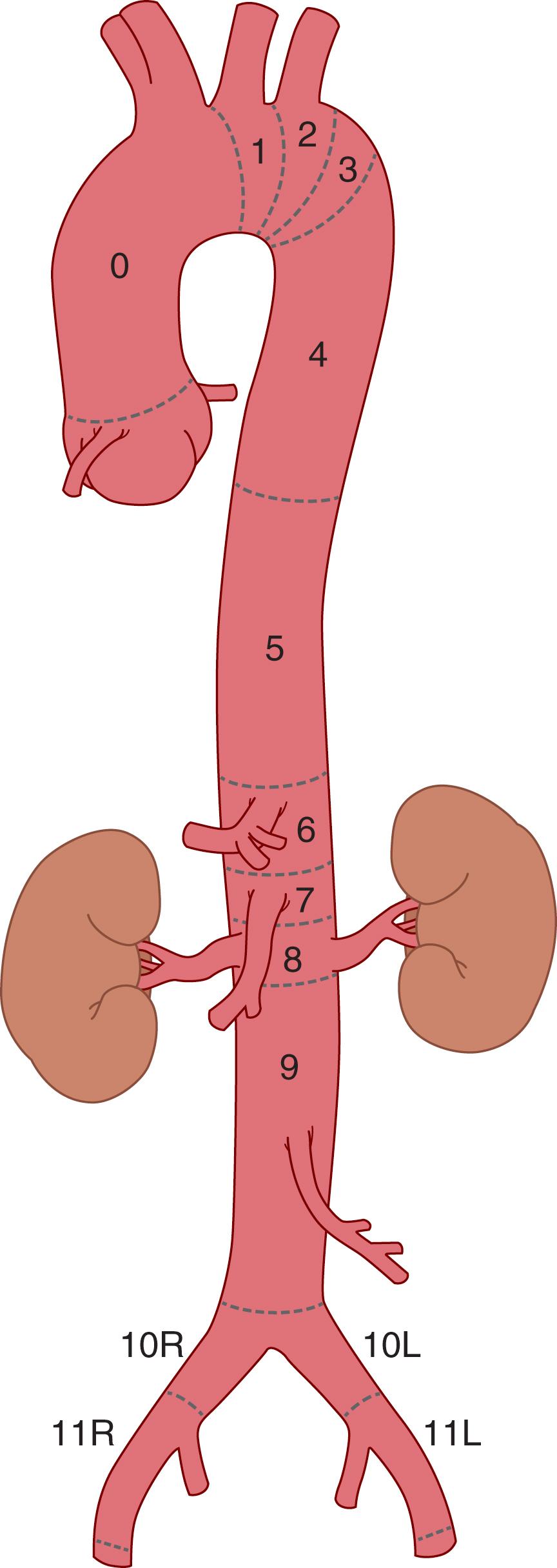 Fig. 62.4, Aortic endograft attachment zones.