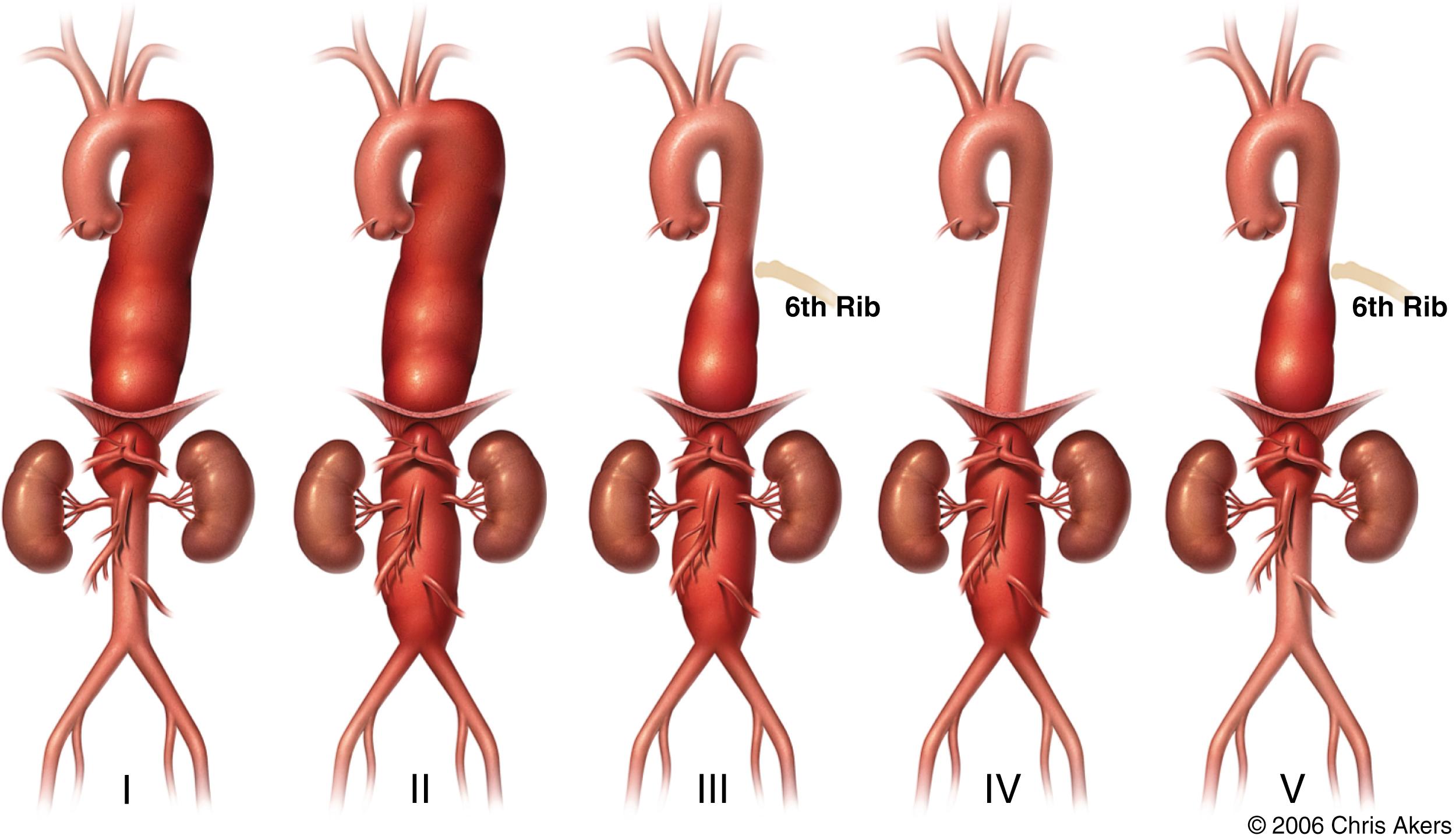 Fig. 62.5, Normal thoracoabdominal aorta aneurysm classification. Extent I, distal to the left subclavian artery to above the renal arteries; Extent II, distal to the left subclavian artery to below the renal arteries; Extent III, from the sixth intercostal space to below the renal arteries; Extent IV, from the twelfth intercostal space to the iliac bifurcation (total abdominal aortic aneurysm); Extent V, below the sixth intercostal space to just above the renal arteries (modified Crawford classification).