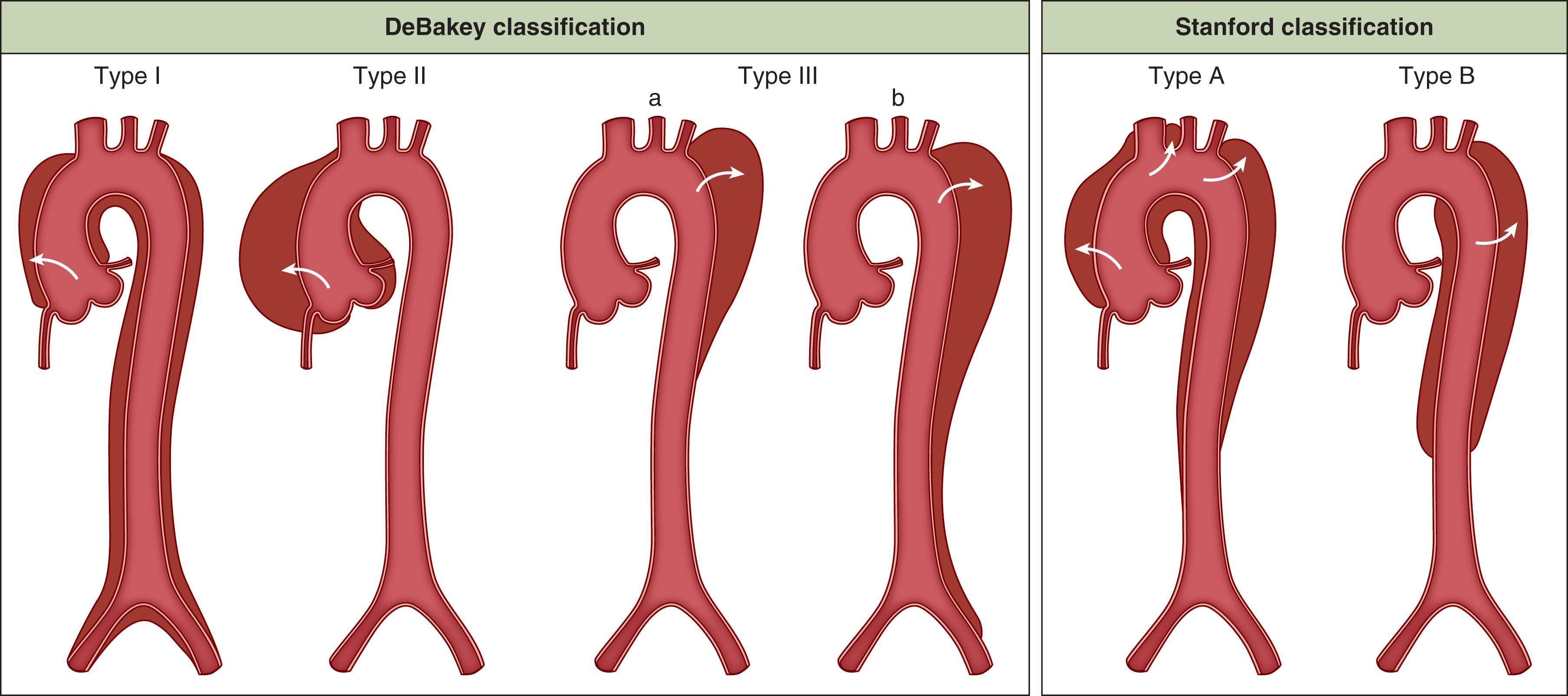 Fig. 62.6, DeBakey (left) and Stanford (right) aortic dissection classifications.