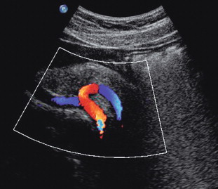 FIGURE 6-2, Transverse view of the coeliac axis showing the splenic artery on the right and the hepatic artery on the left.