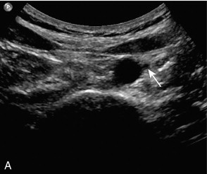 FIGURE 6-4, (A) Transverse scan showing the inferior mesenteric artery lying adjacent to the aorta (arrow); (B) colour Doppler image showing the inferior mesenteric artery and vein (arrows).