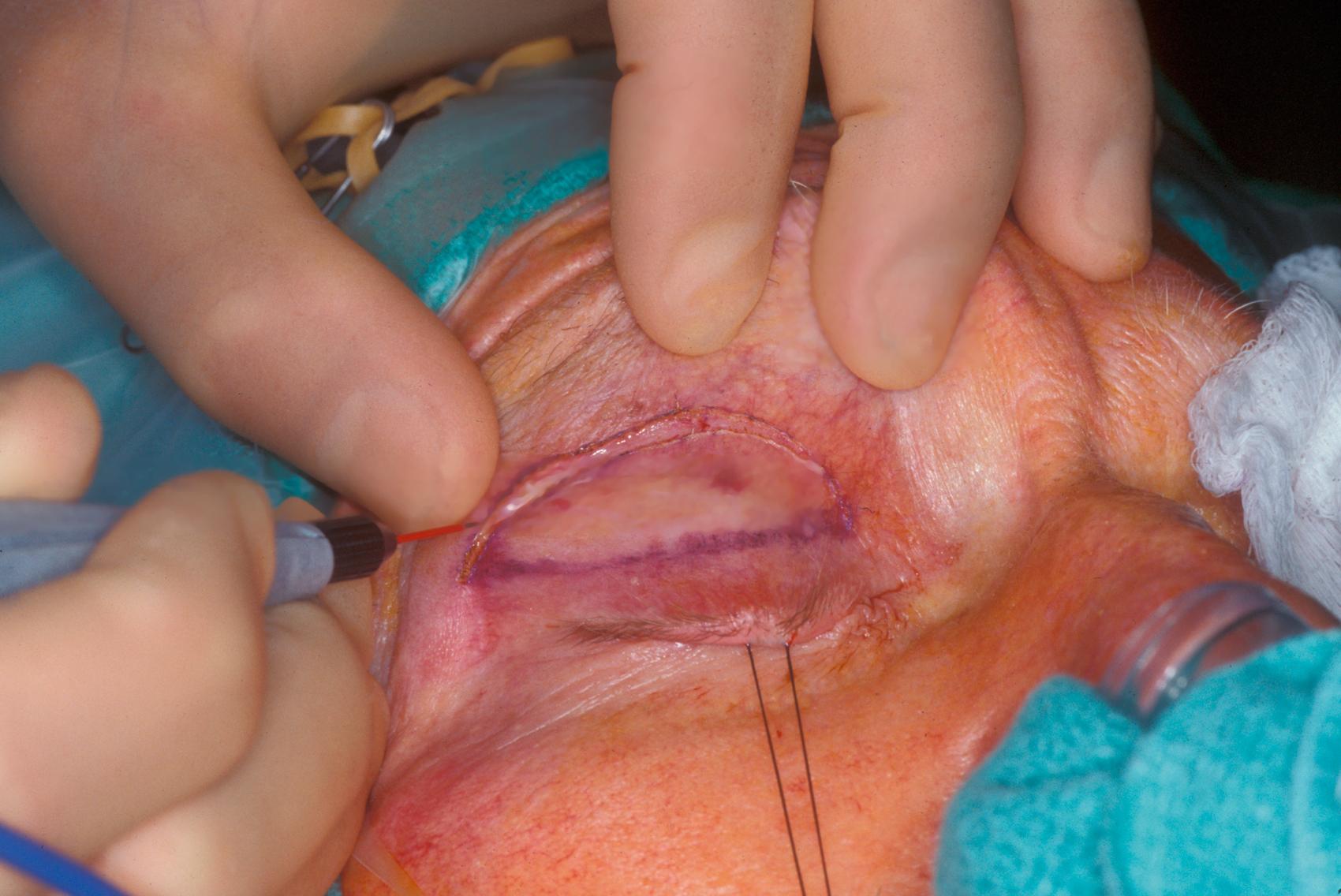 Figure 1.3, Skin stabilization. During upper eyelid blepharoplasty, the skinfold is stabilized and stretched with the surgeon’s fingers while the upper eyelid is drawn downward using a lid margin traction suture. Note that a Colorado microdissection needle* is being used for the incision. With experience, the traction suture can be eliminated and the surgeon can use fingers to stretch the skin tightly.(*The original micropoint electrocautery needle was called the Colorado needle. Other brands of true microdissection needles are now available. In this text, the terms Colorado needle and microdissection needle are used synonymously. However, this fine tungsten microtipped needle should not be confused with the older needle point monopolar cautery tool available in many operating rooms.)