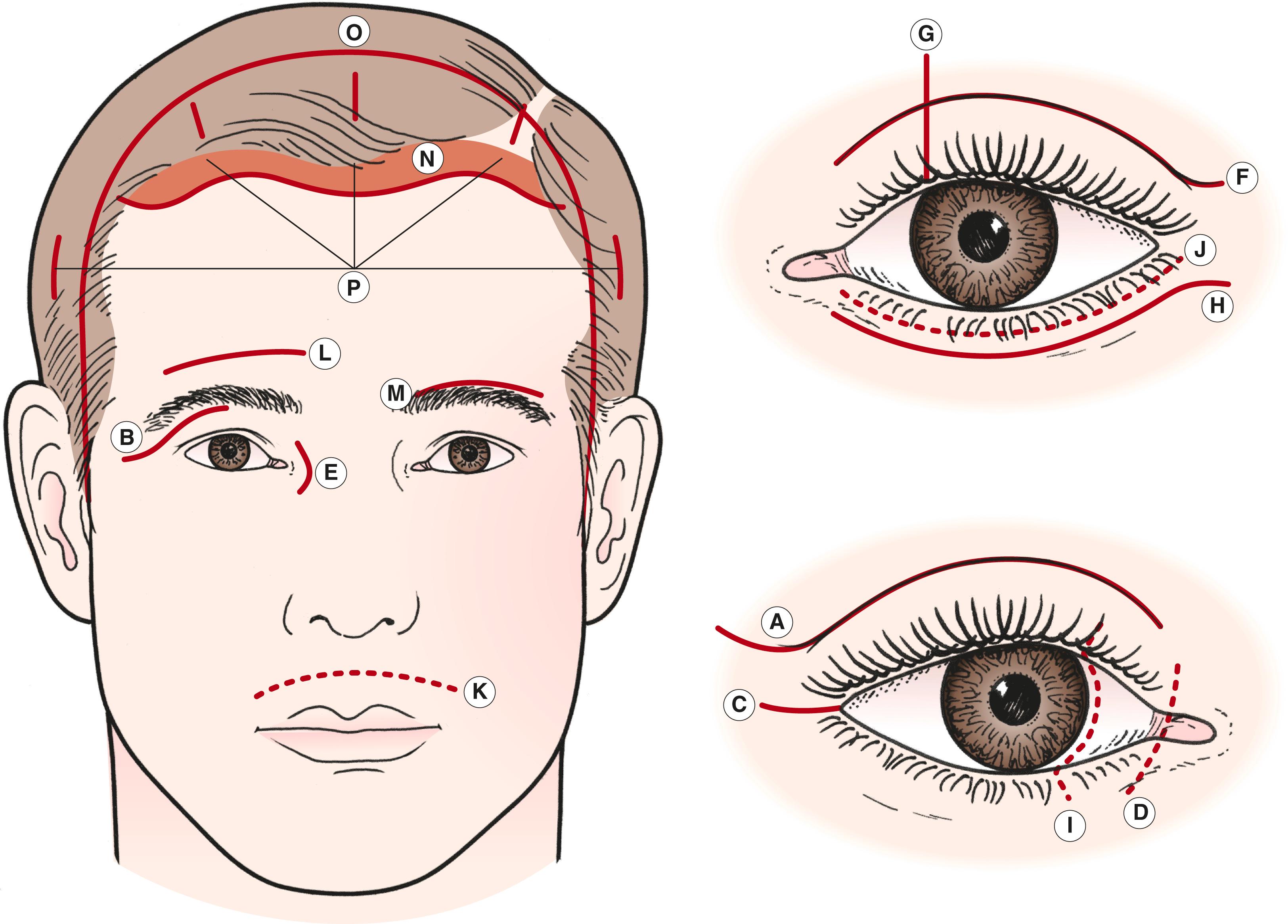 Figure 1.6, Facial incisions are typically hidden in natural skin creases or placed next to anatomic structures for camouflage. A , Upper lid crease incision extended into lateral canthal laugh line for lateral orbitotomy. B , Traditional Stallard–Wright lateral orbitotomy incision (rarely used). C , Modified Berke lateral canthotomy incision. D , Transcaruncular incision. E , Frontoethmoidal (Lynch) incision (rarely used). F , Upper lid crease incision. G , Vertical lid split incision. H , Subciliary incision. I , Transconjunctival incision for medial orbitotomy. J , Inferior transconjunctival incision. K , Gingival upper buccal incision. L , Forehead furrow incision. M , Suprabrow incision. N , Pretrichial incision. O , Transcoronal forehead incision. P , Endoscopic browplasty incisions.