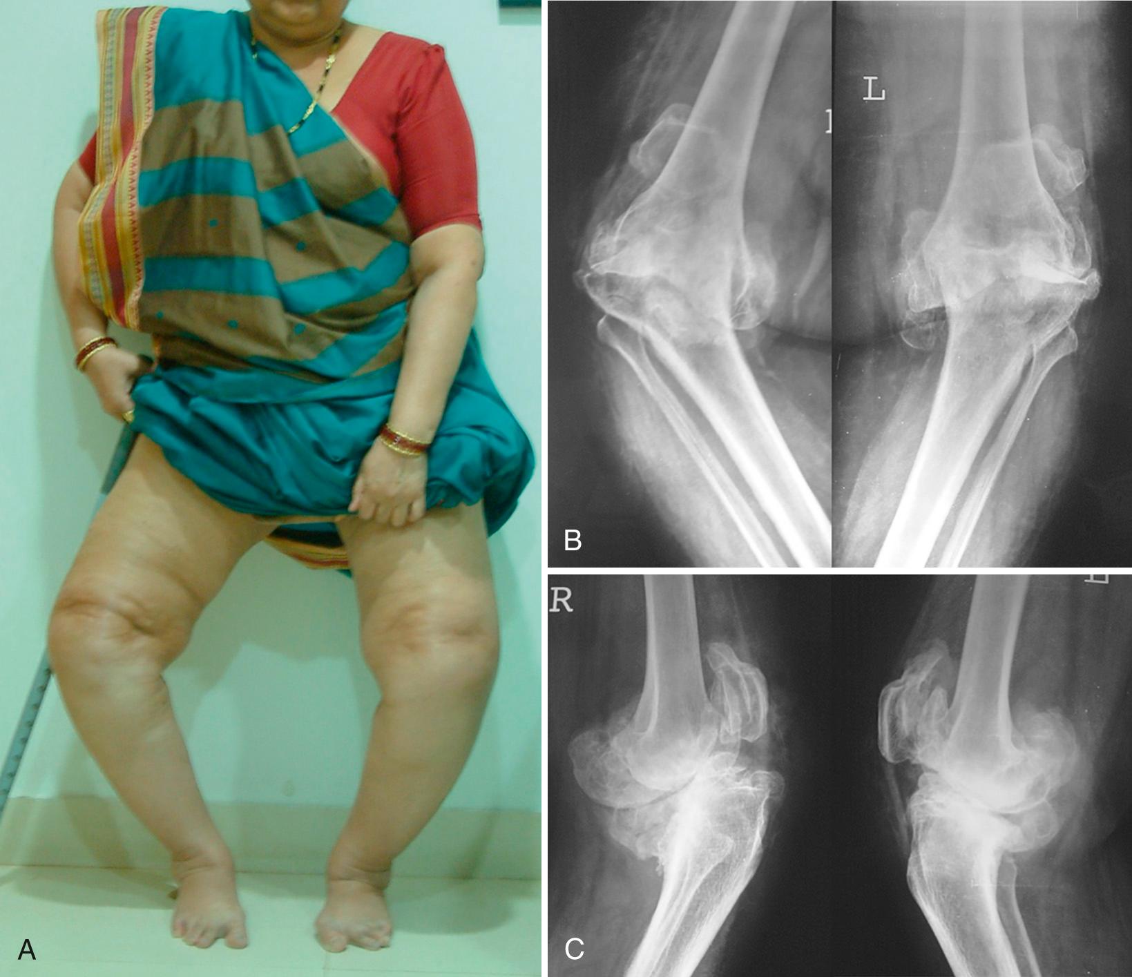 FIG 25.1, Clinical photograph (A) and radiographs (B and C) of a 52-year-old lady with severe OA knees with varus deformity of greater than 10 years' duration.