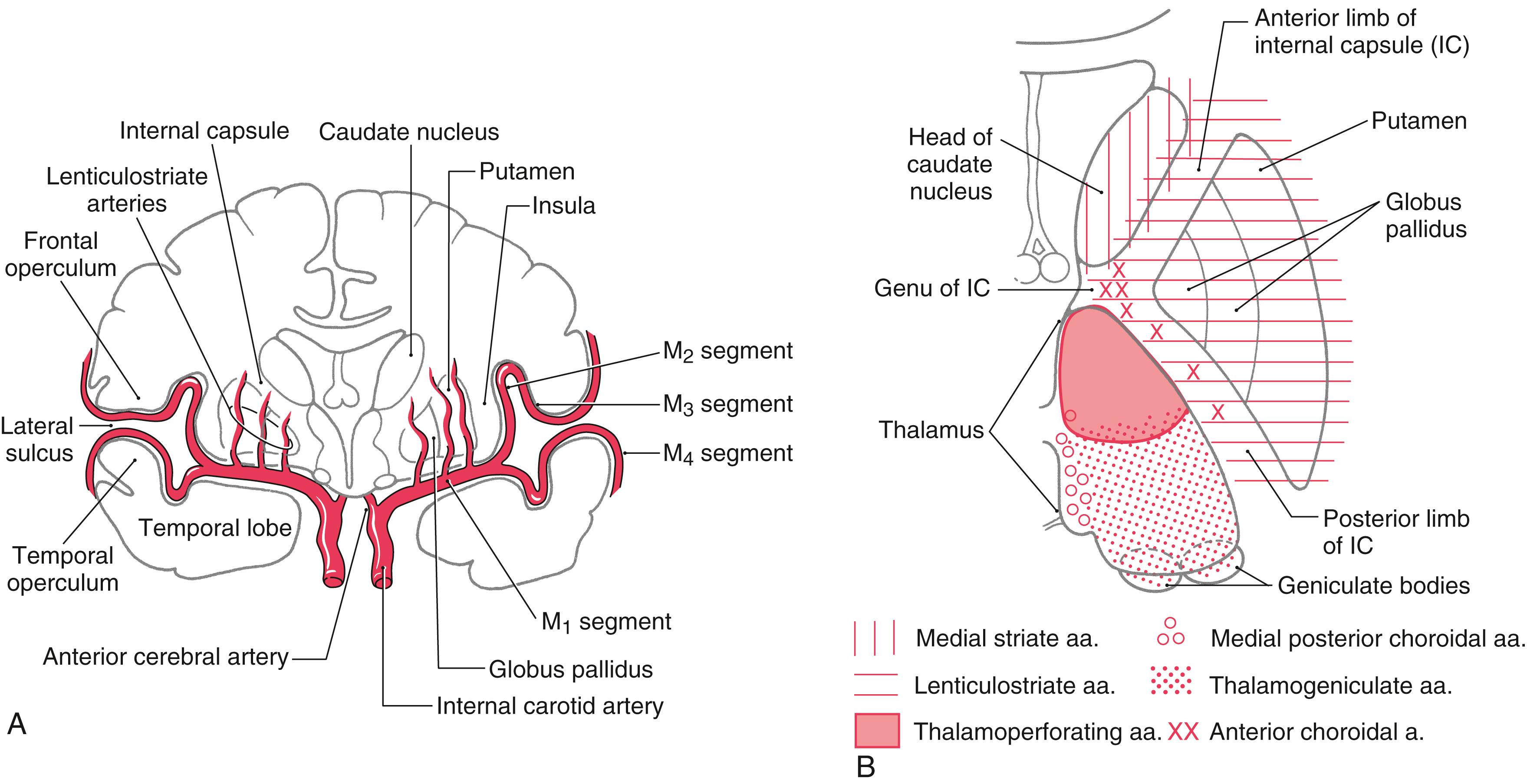 Fig. 26.2, Blood supply to the basal nuclei in coronal ( A ) and axial ( B ) planes. The anterior choroidal artery serves the more inferior aspects of the genu and posterior limb; the more superior aspects are served by the lenticulostriate arteries.