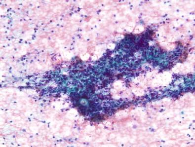 Figure 23-2, Benign (chronic lymphocytic thyroiditis/HT). This image displays a single large lymphoid tangle surrounded by few background lymphocytes. Occasionally, a diagnosis of chronic lymphocytic thyroiditis is rendered based on the lymphocytic component and clinical and/or serological evidence of the disease. Hürthle cell component is helpful for the diagnosis but is not always present in these cases (Papanicolaou, ×LP).