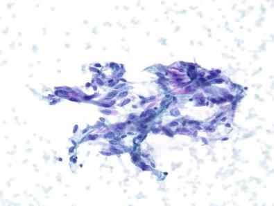 Figure 23-3, Atypia of undetermined significance (AUS). These cells with oval nuclei, nuclear grooves, and pale chromatin were interpreted as atypical with papillary carcinoma as one of the differentials. Follow-up turned out to be a benign cyst. Cyst, lining cells can rarely harbor intranuclear inclusions and are not an uncommon reason for an atypical interpretation (Papanicolaou, ×MP).