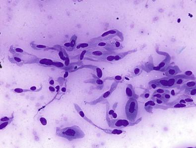 Figure 23-4, Atypia of undetermined significance (AUS). Benign cyst-lining cells in another case originally diagnosed as “AUS”. The long tapering cytoplasmic tails and occasional binucleation clearly argues against a papillary carcinoma interpretation. The cystic component may be small and not apparent of scans in some of these cases leading to an overcall as “AUS” (Diff-Quik, ×HP).