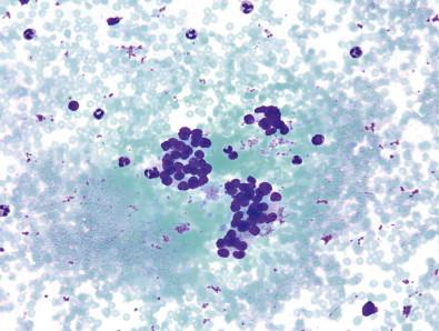 Figure 23-5, Atypia of undetermined significance (AUS). This case displays scant epithelium with suggestion of microfollicular architecture. No colloid was apparent. Follow-up revealed papillary thyroid carcinoma, follicular variant (Diff-Quik, ×MP).