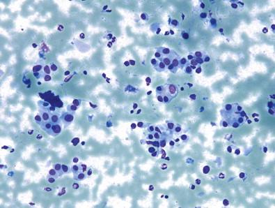 Figure 23-6, Atypia of undetermined significance (AUS). Another example depicting follicular epithelium with Hürthle cell change. Some microfollicles are also apparent. Follow-up showed HT. On retrospective review, a small number of background lymphocytes are noted (Diff-Quik, ×MP).