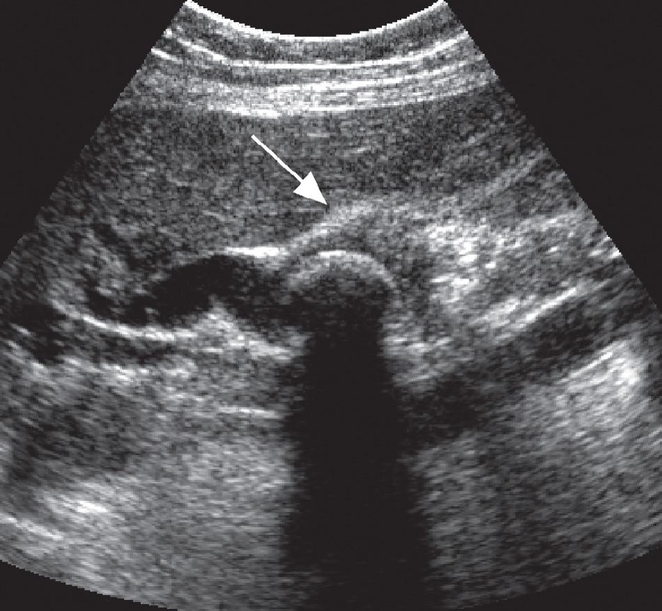 FIG. 6.11, Mirizzi Syndrome.