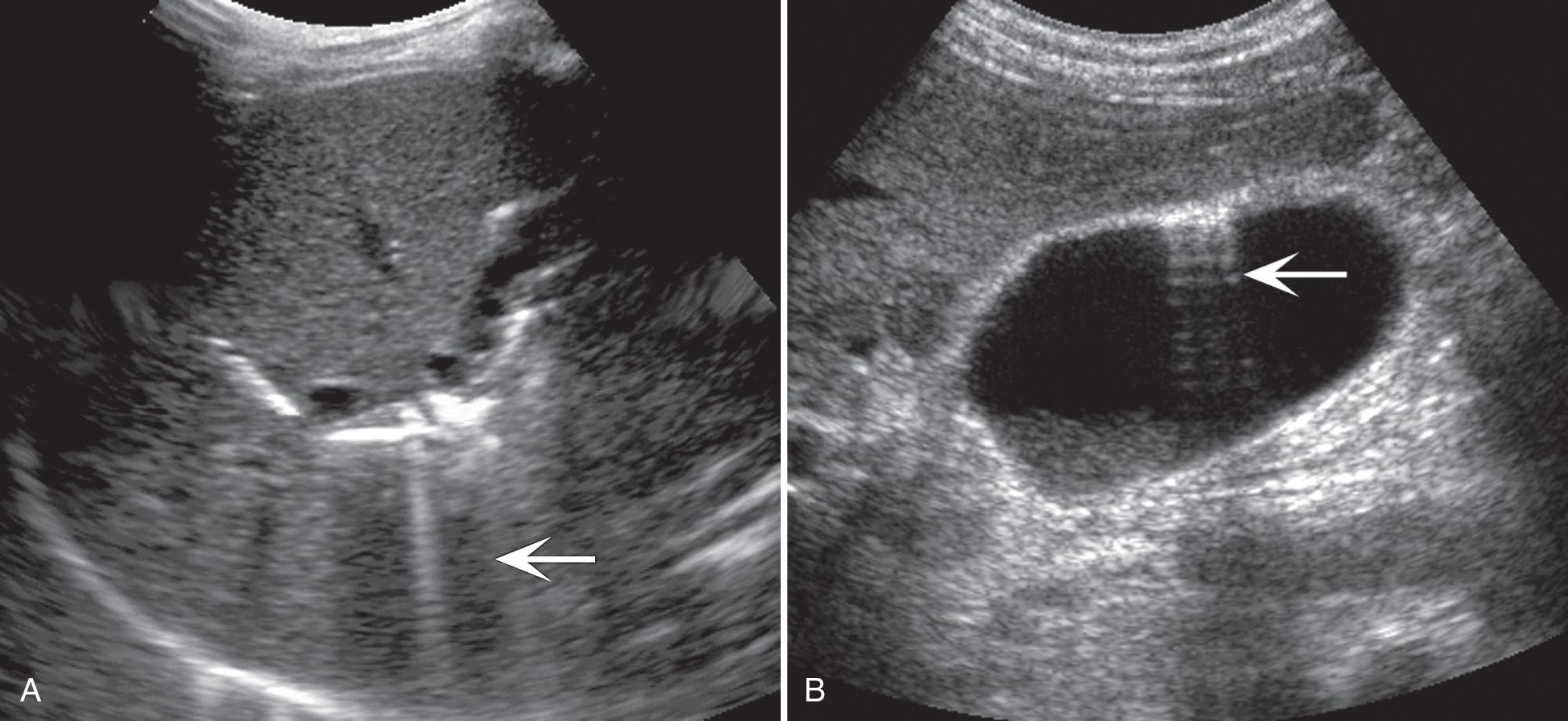 FIG. 6.13, Pneumobilia.