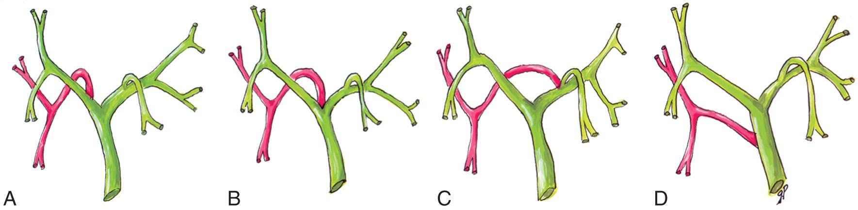 FIG. 6.2, Common Variants of Bile Duct Branching.