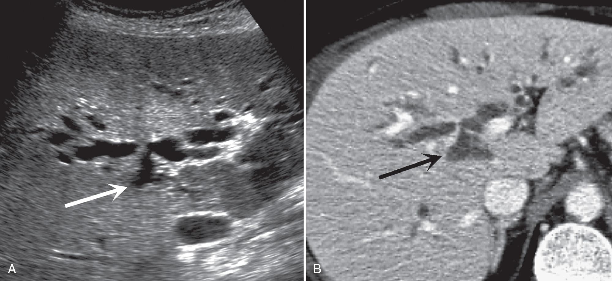 FIG. 6.4, Aberrant Right Posterior Duct.