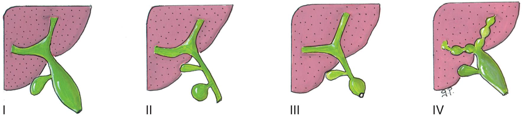 FIG. 6.6, Todani Classification System for Choledochal Cysts.