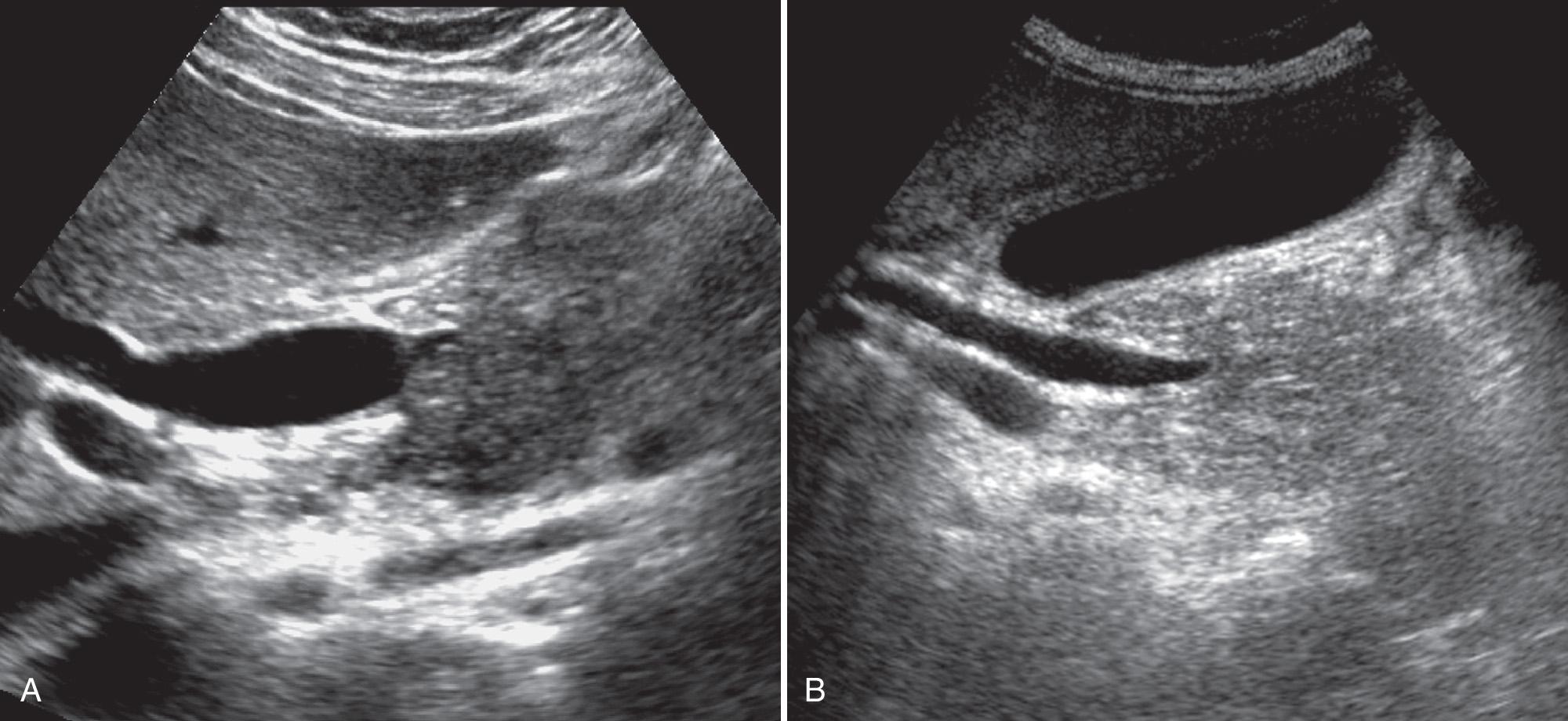FIG. 6.9, Common Bile Duct Obstruction Caused by Extrinsic Factors.