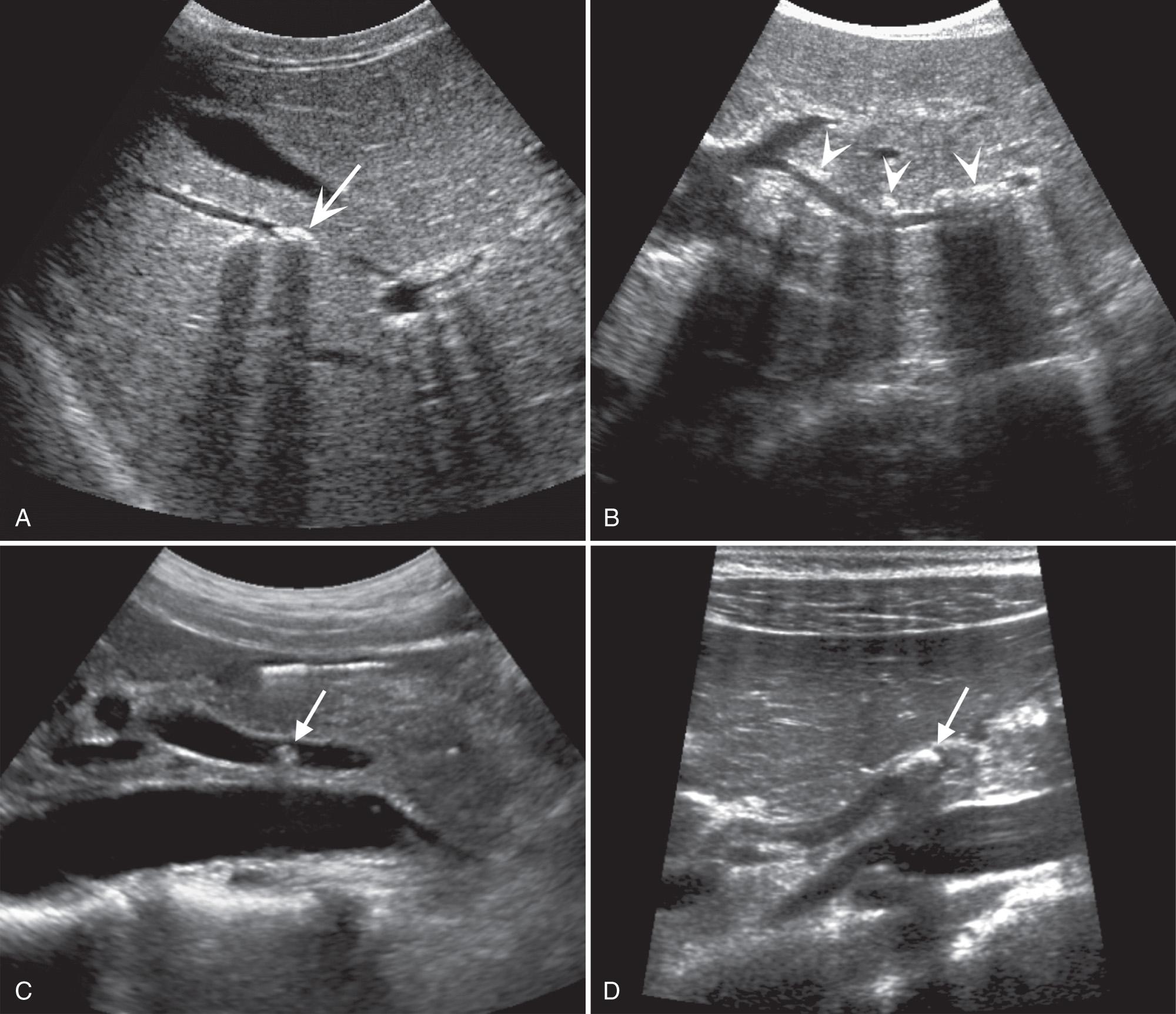 FIG. 6.10, Choledocholithiasis.