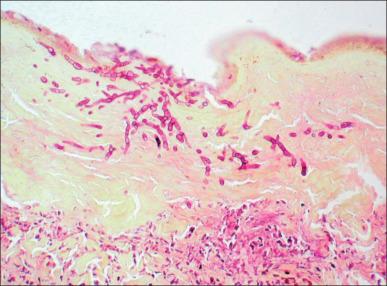 Fig. 44.2, Micrograph showing fungal hyphae within necrotic tissue extending close to the boundary with intact, viable dermal tissue. Periodic acid–Schiff stain.