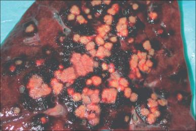 Fig. 44.3, Photograph showing a slice of the upper lobe of the lung taken at autopsy from a patient who showed clinical signs of sepsis when he developed disseminated infection after multiple wound cultures of open wounds yielded multiple antibiotic-resistant Pseudomonas spp.