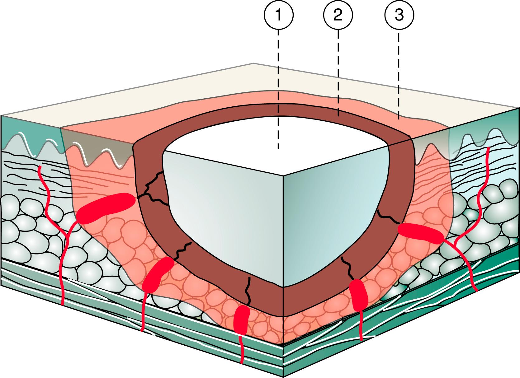 Fig. 57.1, Model of burn wound pathophysiology. The zone of stasis may convert to a zone of necrosis if insufficient fluid resuscitation is administered.