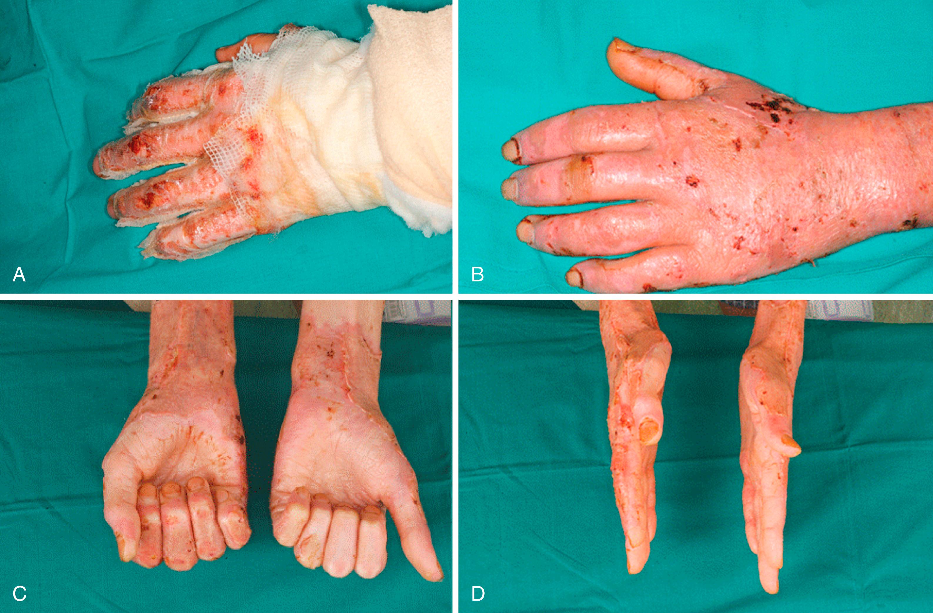 Fig. 57.11, A, Biobrane glove fitted to a superficially burned hand. B to D, Excellent cosmetic and functional result after spontaneous healing.