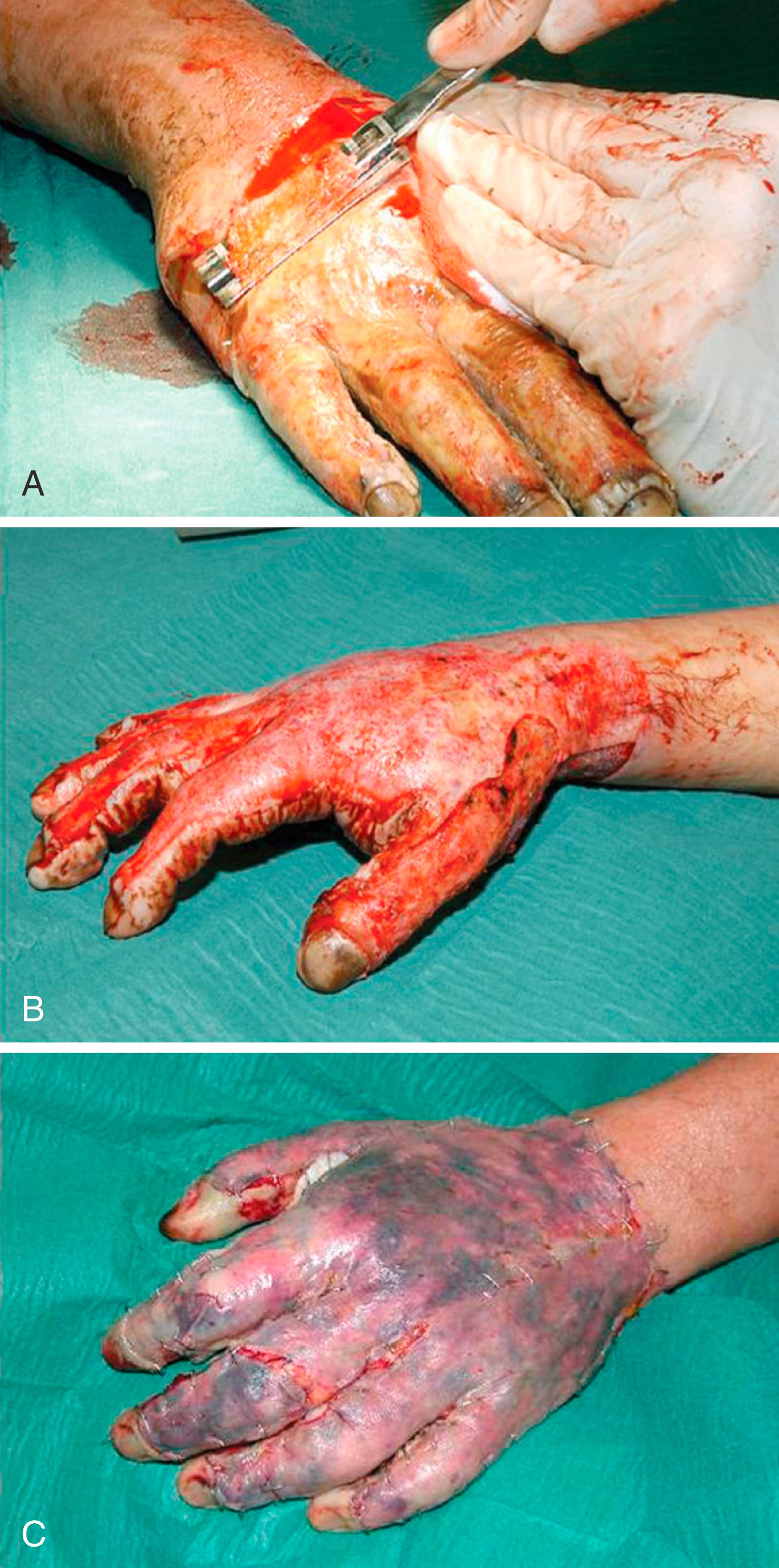 Fig. 57.12, A, Tangential excision of a deep partial-thickness burn on the dorsum of the hand. B, Sheet graft transplantation to the excised areas. C, Short-term postoperative result after sheet graft transplantation.