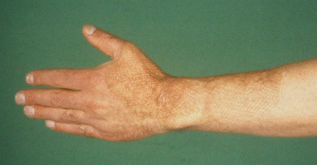 Fig. 57.13, Cosmetic result of a meshed skin graft transplant on the hand.