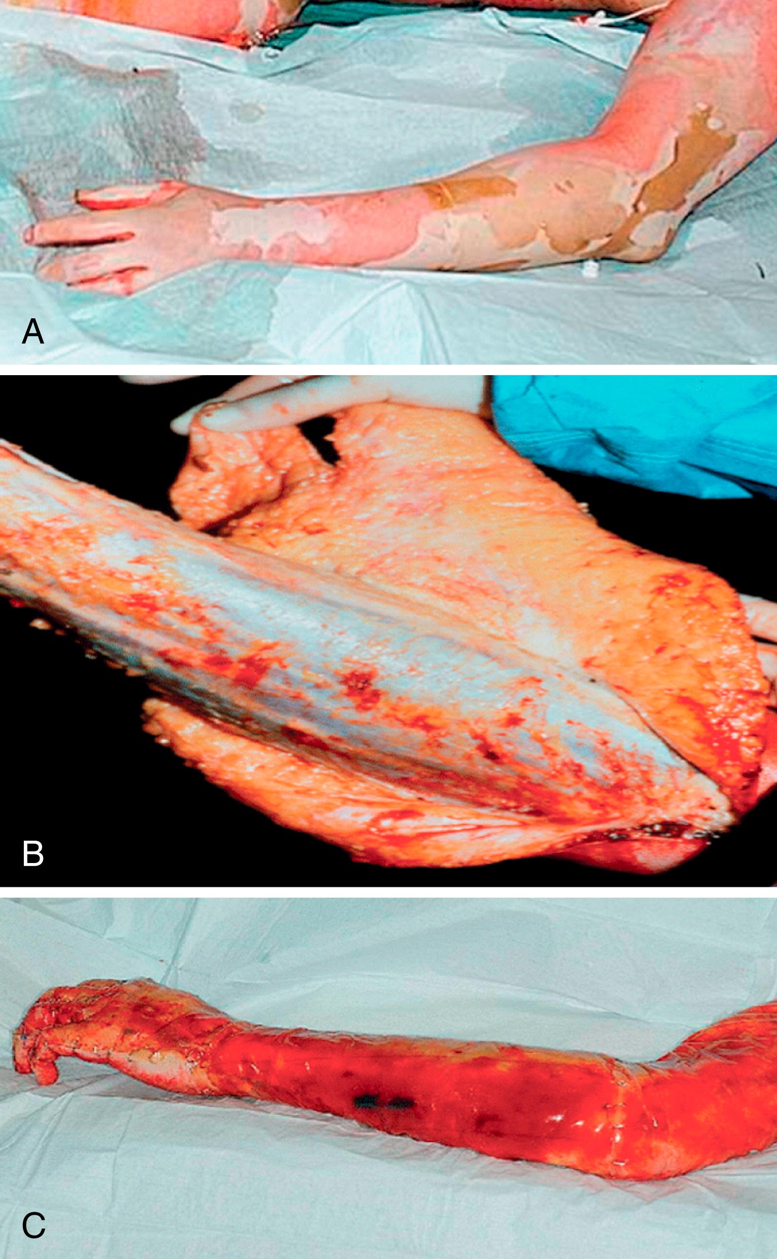 Fig. 57.14, A, Deep full-thickness burn on the left upper extremity. B, Epifascial excision of a severe full-thickness burn on the left upper extremity. C, Application of Integra to the extremity.