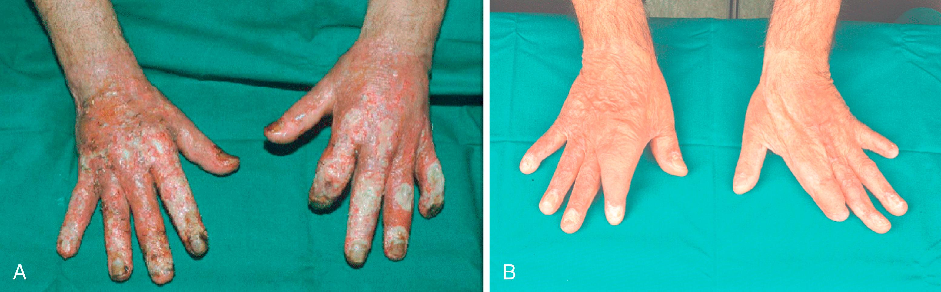 Fig. 57.15, A, Deep contact burn on both hands with exposed PIP joints after failed skin grafts. B, Result after the application of free serratus fascia flaps to both hands with skin grafts.