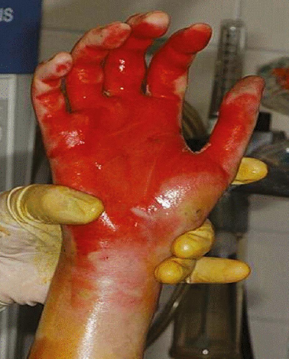 Fig. 57.4, Deep partial-thickness second-degree burn of the palm. The burn will heal spontaneously because of the healing capacity of the palmar skin.