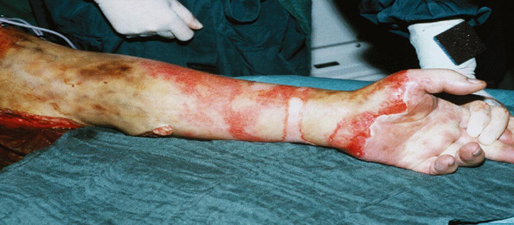 Fig. 57.5, Deep partial-thickness and full-thickness third-degree burns of the forearm. These burns will require excision and grafting.