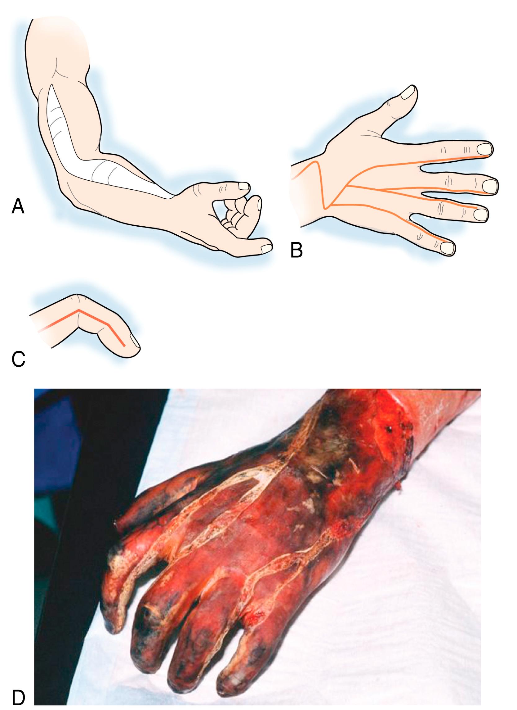 Fig. 57.6, A, Schematic illustration of escharotomy incisions in the upper extremity. B, Escharotomy incisions in the dorsum of the hand. C, Clinical situation after escharotomy of the dorsum of the hand. D, Escharotomy incisions in the digits, midlateral view.