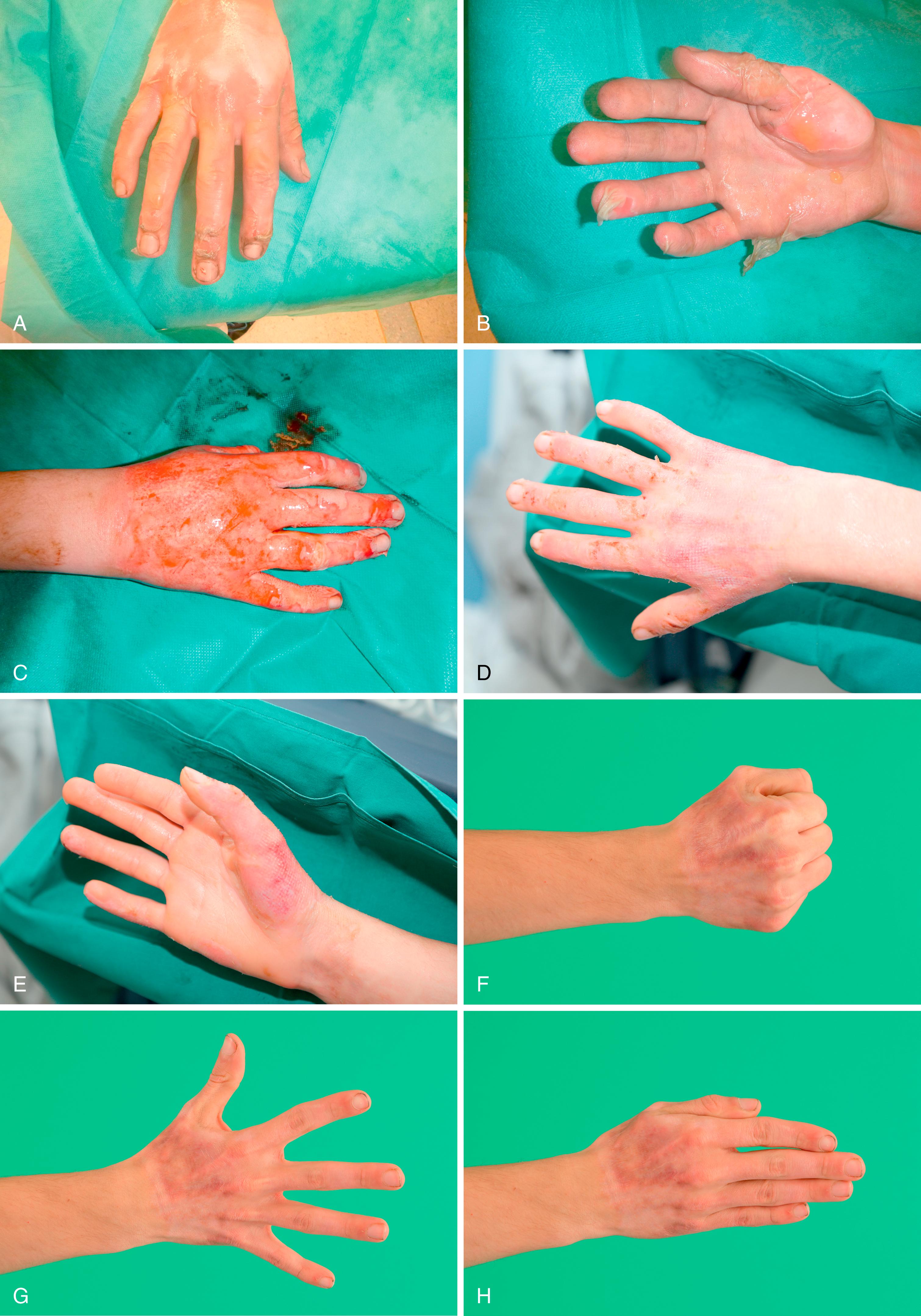 Fig. 57.7, A and B, Partial/deep partial hand burn. C, Status post enzymatic debridement with Nexobrid™. D and E, Complete epithelialization. F to H, Functional and esthetic result.