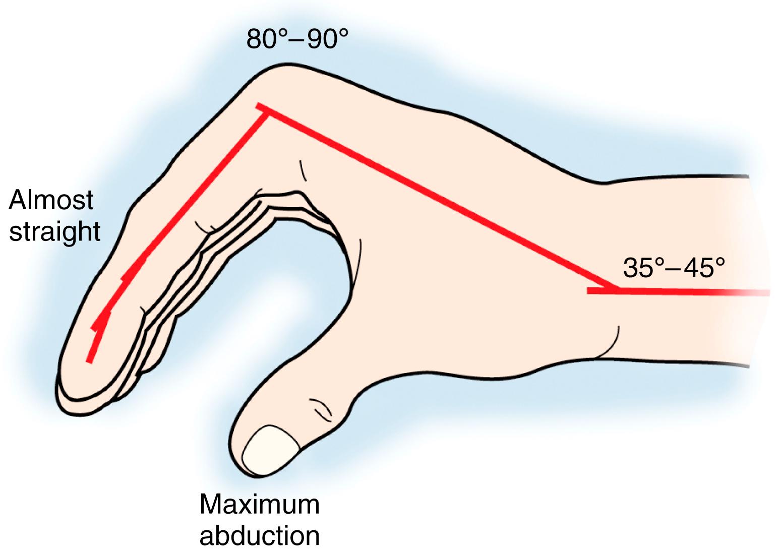 Fig. 57.8, Ideal splinting position for the hand.