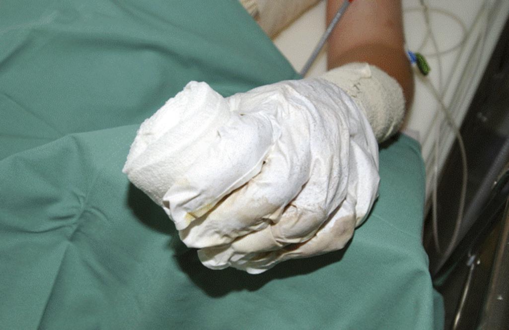 Fig. 57.10, Gore-Tex glove filled with silver sulfadiazine for conservative treatment of a superficial partial-thickness second-degree burn.