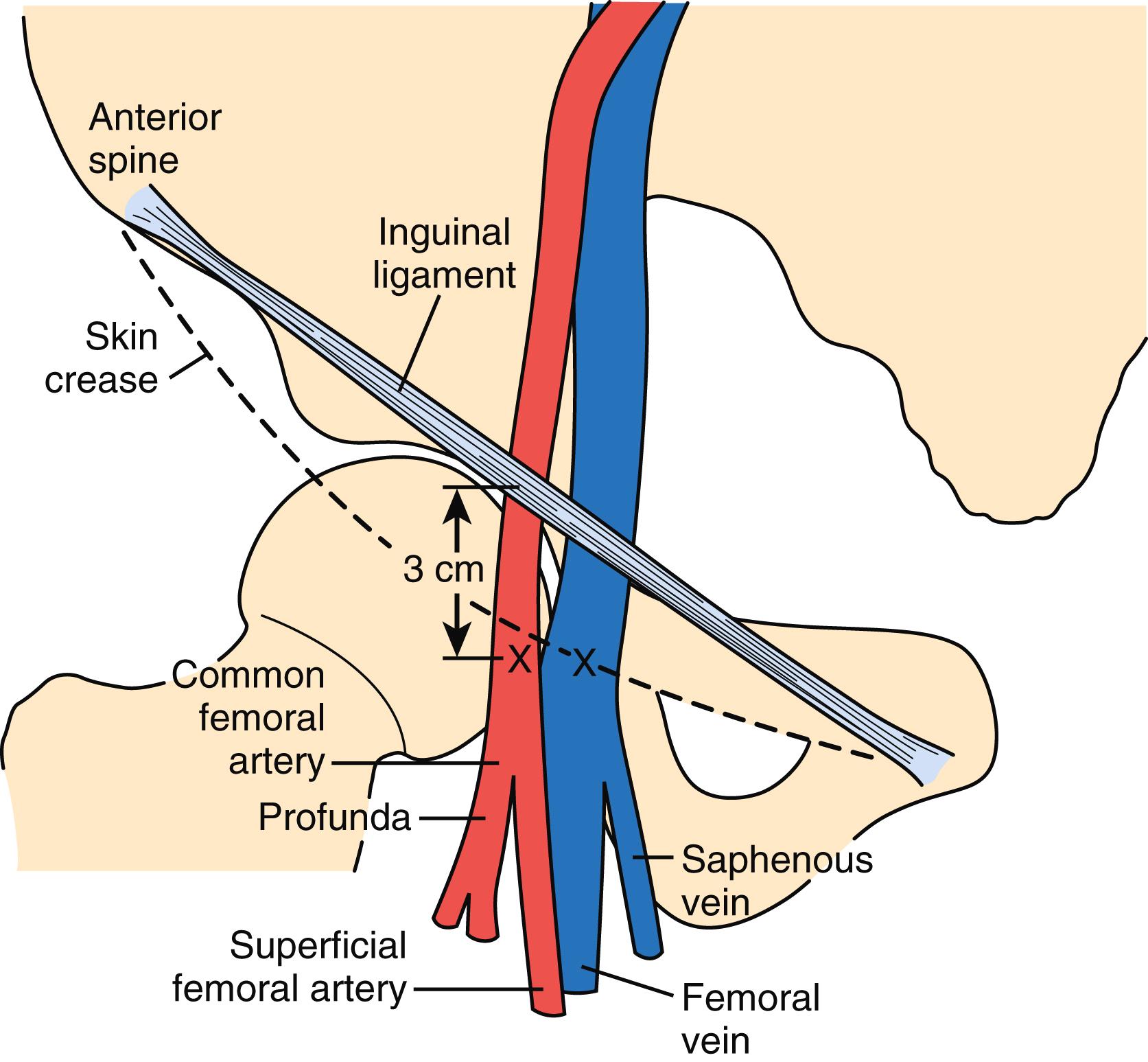 Figure 2.2, Relevant anatomy for percutaneous catheterization of the femoral artery and vein. The right femoral artery and vein run underneath the inguinal ligament, which connects the anterior-superior iliac spine and the pubic tubercle. The arterial puncture should be made approximately 1.5 to 2 fingerbreadths (3 cm) below the inguinal ligament and directly over the femoral artery pulsation. The venous puncture should be made at the same level but approximately 1 fingerbreadth medial to the arterial position. X , Puncture site.