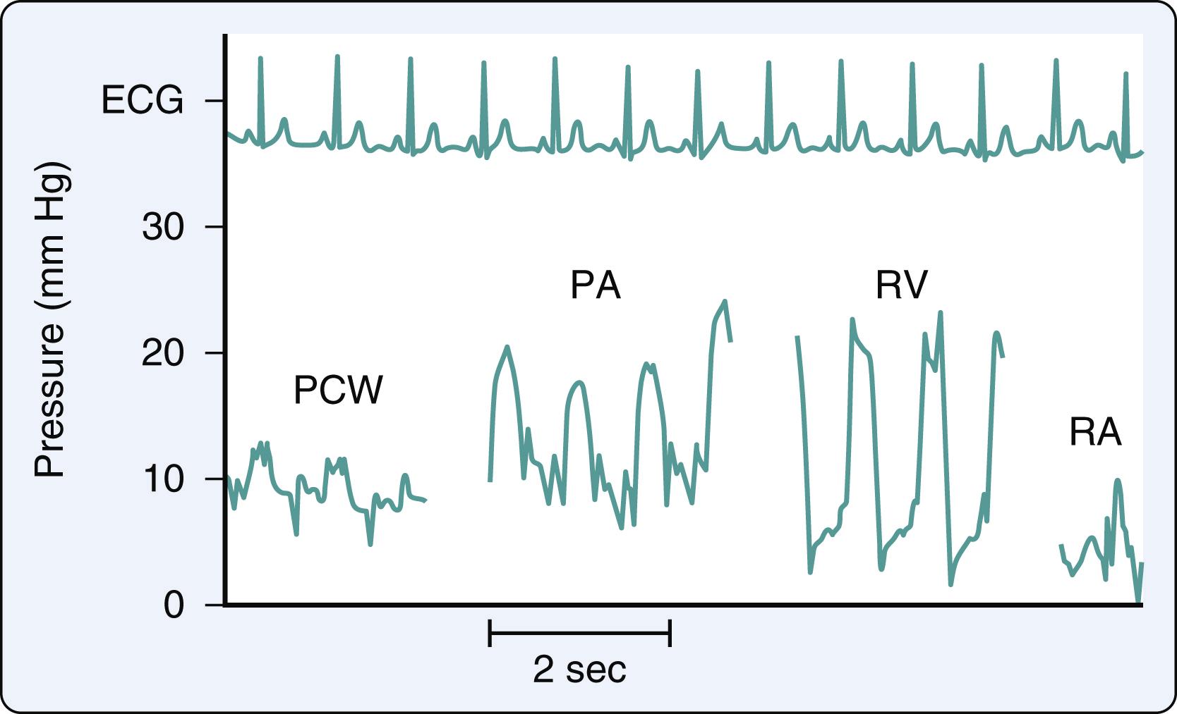 Figure 2.4, A pullback tracing obtained using a pulmonary artery catheter from the pulmonary capillary wedge (PCW) position, to the pulmonary artery (PA) , right ventricle (RV) , and right atrium (RA) . ECG , electrocardiogram.